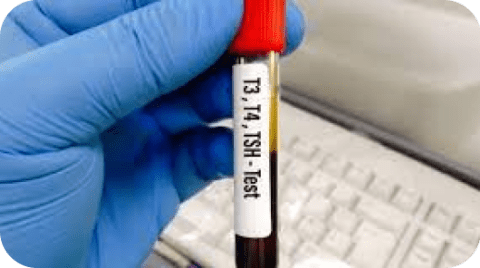 Tnih Lab Test Thyroid Blood Test - LAB ON DEMAND